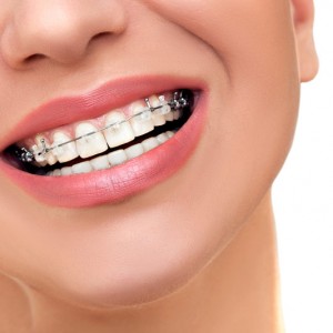 Invisalign ZÃ¼rich